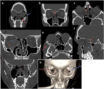 A Functional Radiological and Soft Tissue Classification to Predict Outcomes in Orbital Fracture Surgery in a Multidisciplinary “Real-World” Setting